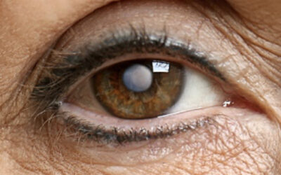 Cataract – Simply Explained