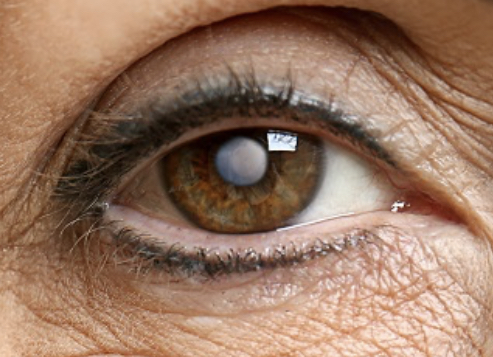 Cataract – Simply Explained
